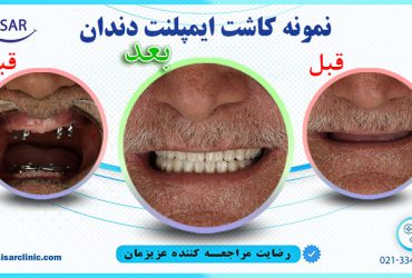 نمونه کاشت ایمپلنت دندان