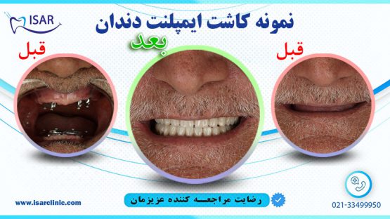 نمونه کاشت ایمپلنت دندان