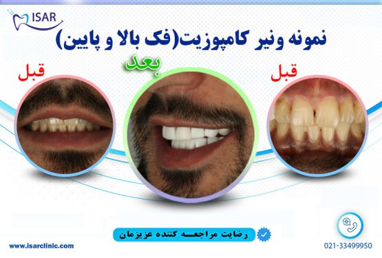 قبل و بعد از کامپوزیت دندان
