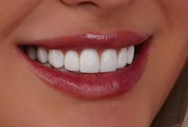 cost of dental bleaching in tehran