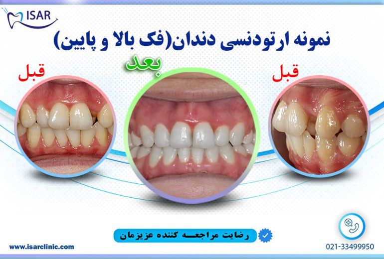 کار ارتودنسی دندان2